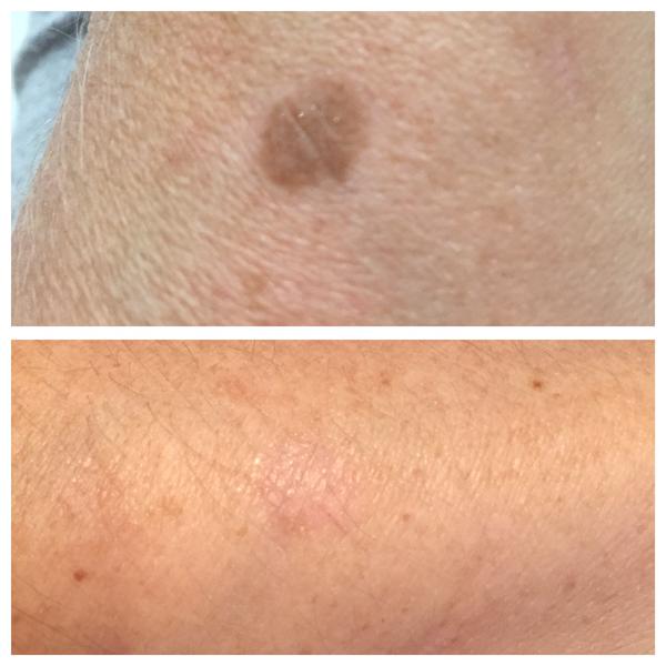 Age spot pigmentation before and after cryotherapy treatment